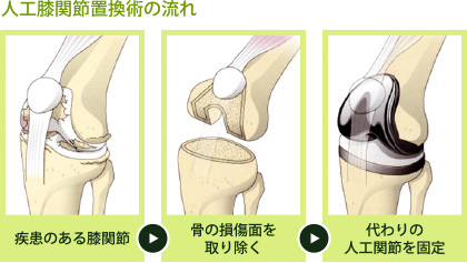 人工関節について | 人工関節センター | 愛媛大学医学部附属病院