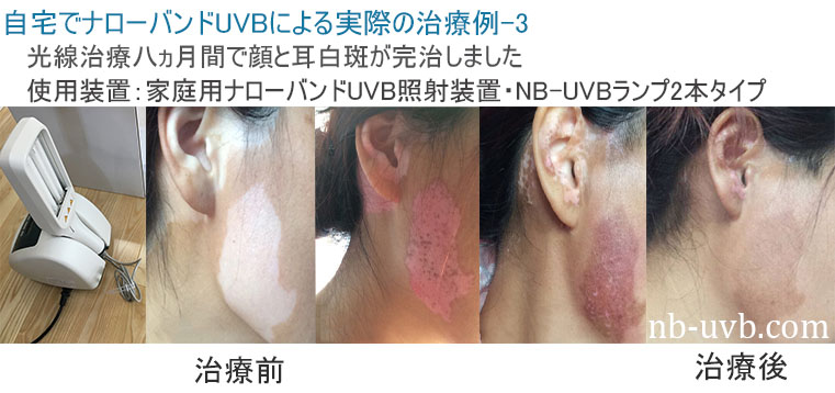 家庭用ナローバンドUVB(311)/エキシマ(308)紫外線治療器[個人輸入